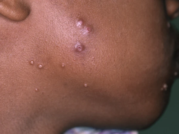 Derm Image - Facial Lesions,	Molluscum Contagiosum 