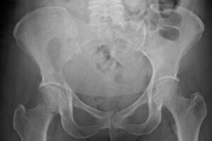 hip pain, lytic lesion in 4-year-old girl on hip
