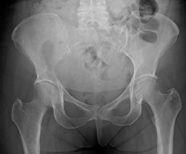 XR 1 - Right-sided pelvic pain, Lytic lesion on medial iliac bone, mass