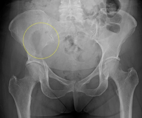XR 2 - Right-sided pelvic pain, Lytic lesion on medial iliac bone, mass circled