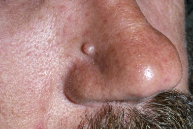 52-Year-Old With a Lateral Nasal Growth