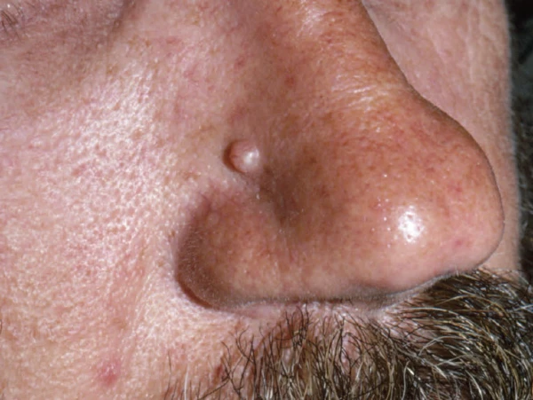 Lateral Nasal Growth