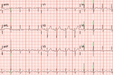 66-Year-Old With Weakness and Dyspnea