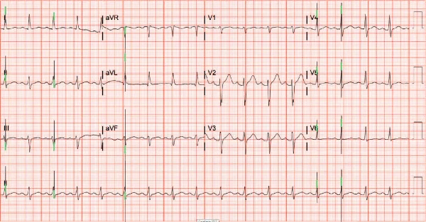 ECG 1