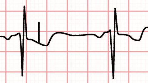 Weakness and Dyspnea ECG 2 - Failure to sense