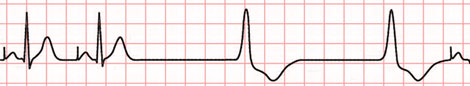 Weakness and Dyspnea ECG 3 - Failure-to-pace
