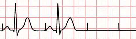 ECG Figure 4. Failure-to-capture.