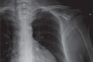 multiple left-sided rib fractures and rightward tracheal deviation