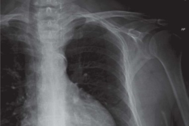 75 Year Old With Rib Pain