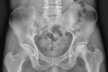 47-Year-Old With Left Hip Pain