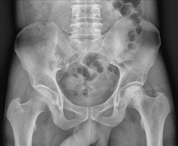 Pelvis x-ray left hip pain, avascular necrosis of the femoral head