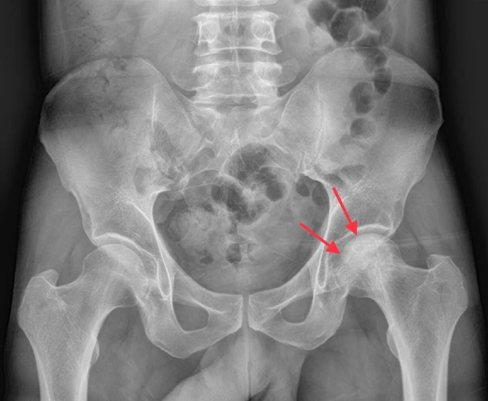 Pelvis X-ray, Left Hip, avascular necrosis of the femoral head