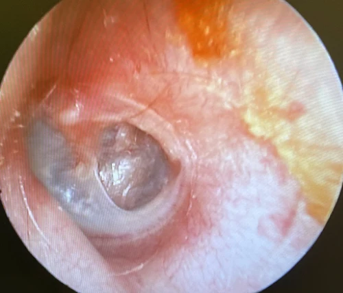 Right Tympanic Membrane with posterior superior retraction pocket notice the thinning of the retraction-pocket compared to the rest of the tm
