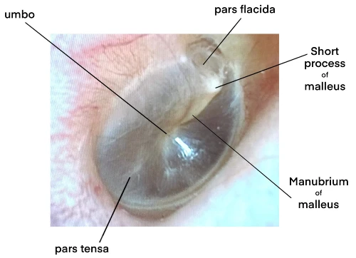 Figure 1 Normal Tympanic Membrane Landmarks