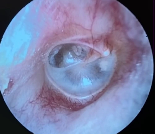 Right Tympanic Membrane with-significant posterior superior retraction notice the outline of the stapes bone posterior to the manubrium of the maleus and umbo this should not normally be seen