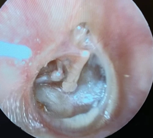 Left Tympanic Membrane with posterior superior retraction pocket