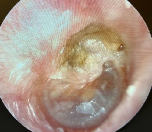 Tympanic Membrane Posterior Superior Retraction Pocket