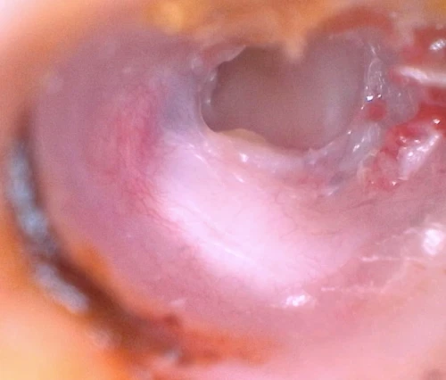 Right Sided Pars Flacida Cholesteatoma