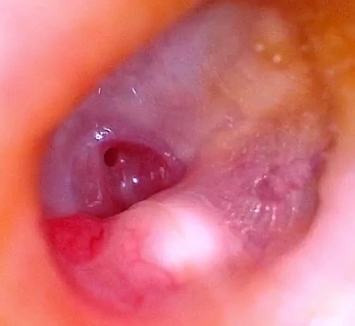 inflammatory-changes-of-right-tm-with-posterior-inferior-cholesteatoma