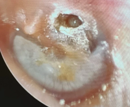 Left Cholesteatoma Formation in Posterior Superior Pars Tensa