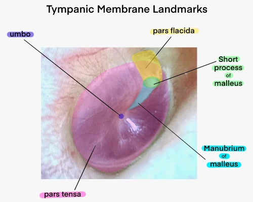 figure 2 normal tympanic membrane landmarks