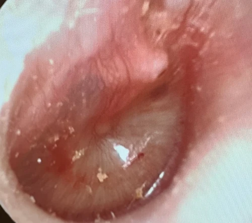 Figure 26 Right Sided Resolving Adult AOM Purulence Noted in Inferior Middle Ear