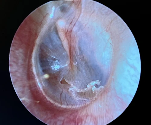 Figure 27 Traumatic Micro TMP Of Left Ear Inferior To umbo
