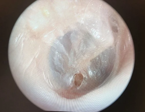 Figure 28 Traumatic TMP of Right Ear