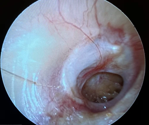 Figure 29 Chronic TMP of Right Ear