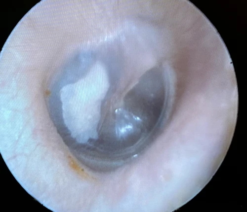 Right Tympanic Membrane with Posterior Myringosclerosis