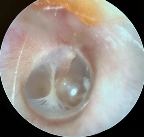 Right Tympanic Membrane with Inferior Myringosclerosis