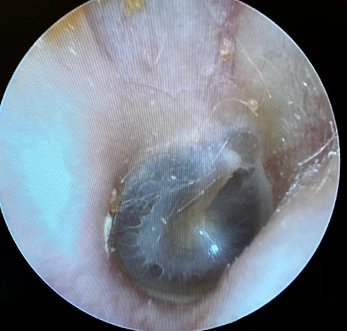 right tm with mild peripheral myringosclerosis giving appearance of bubbles or fluid in middle ear