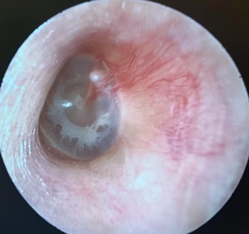 Left Tympanic Membrane with Peripheral Myringosclerosis Giving Appearance of Bubbles or Fluid in inferior middle ear
