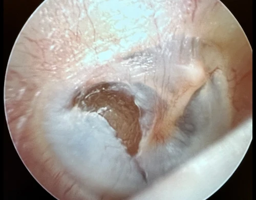 Right Tympanic Membranewith More extensive Myringosclerosis the Posterior Translucent portion of tm may be mistaken as a perforation