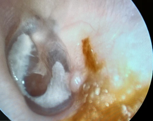 Left Tympanic Membrane with horseshoe myringosclerosis there is no perforation inferior to the umbo