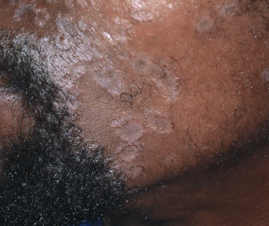 Asymptomatic Rash in 51-year-old Male
Seborrheic Dermatitis