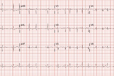 64-Year-Old With Dyspnea and History of COPD