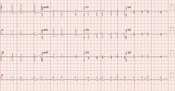 Multifocal atrial tachycardia (MAT)