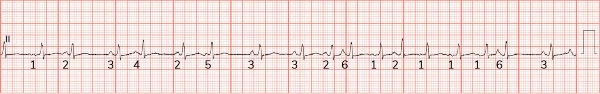 Multifocal atrial tachycardia (MAT), Note 6 distinct P wave morphologies (numbered) in the lead II rhythm strip as well as the variable P-P intervals.