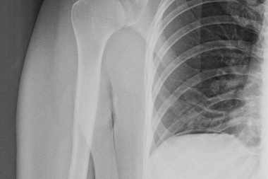 25-Year-Old With Shoulder Pain