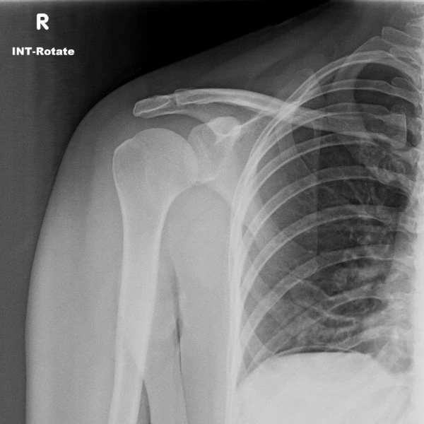 pneumoperitoneum