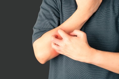 Staph Bacteria Implicated as the Cause of Itchy Skin 