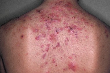 18-Year-Old With Painful, Eroded Lesions