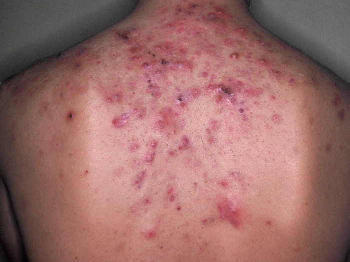 18-Year-Old With Painful, Eroded Lesions