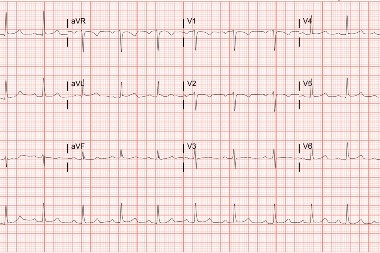 42 Year-Old With Facial Pain and History of Hypertension