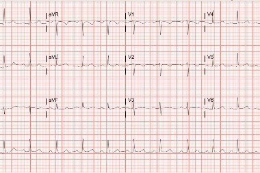 42 Year-Old With Facial Pain and History of Hypertension