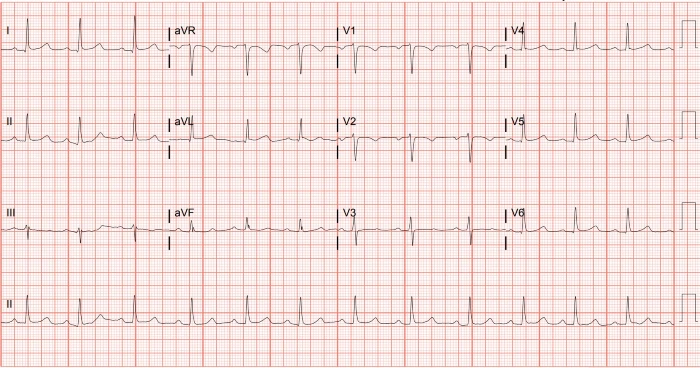 Facial Pain and History of Hypertension Initial ECG