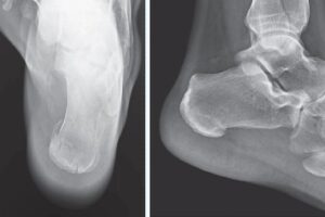 35-Year-Old With Heel Pain After a Fall X-ray Image