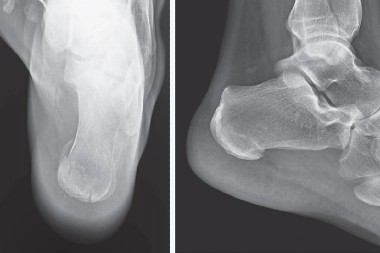 35-Year-Old With Heel Pain After a Fall