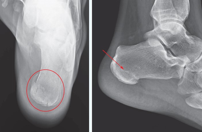 Calcaneus Fractures Workup: Laboratory Studies, Plain Radiography, Computed  Tomography